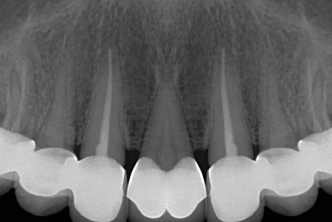 Wurzelbehandlung (Endodontie) in München